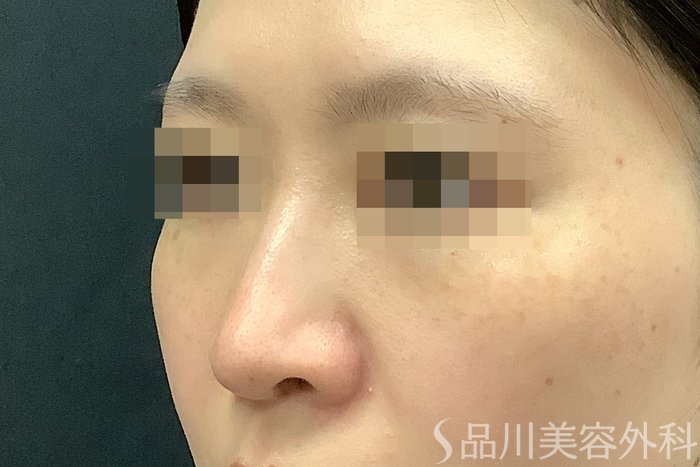 症例NO.71249のBEFORE写真