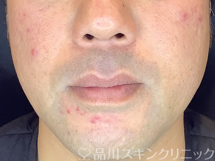 症例NO.65638のBEFORE写真