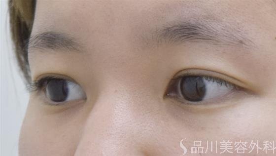 症例NO.52539のBEFORE写真