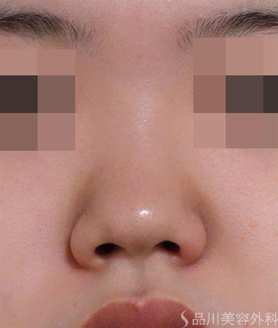 症例NO.40272のBEFORE写真