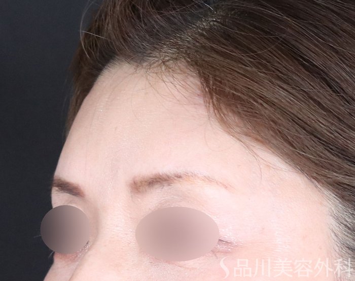 症例NO.72691のAFTER写真