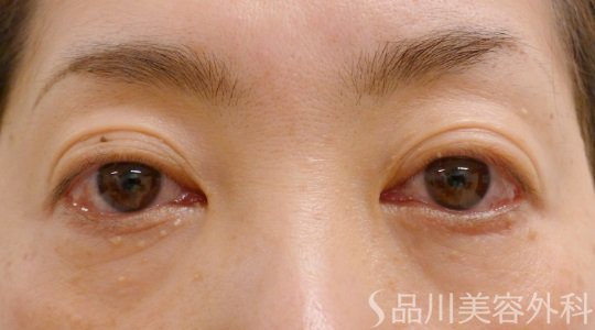 症例NO.62285のBEFORE写真