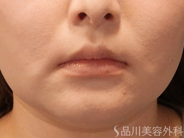 症例NO.69872のBEFORE写真