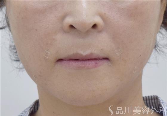 症例NO.49182のAFTER写真