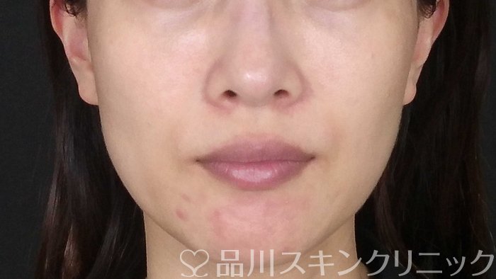 症例NO.71980のBEFORE写真