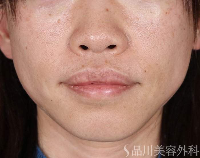 症例NO.72418のAFTER写真