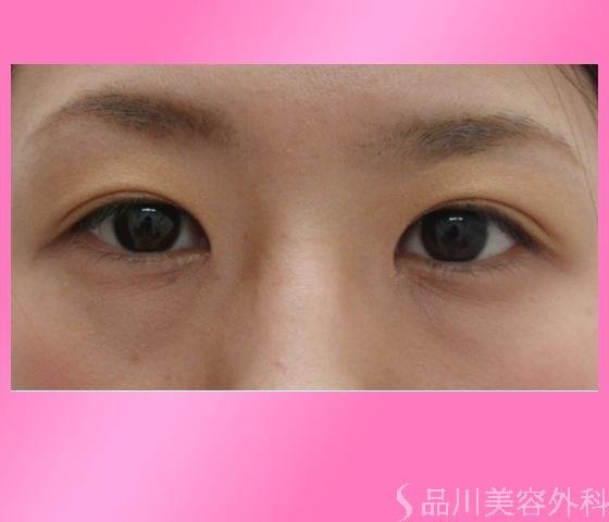 症例NO.2528のAFTER写真