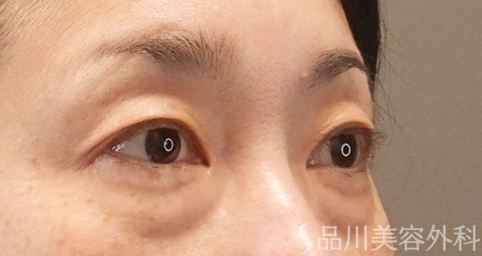 症例NO.70973のBEFORE写真