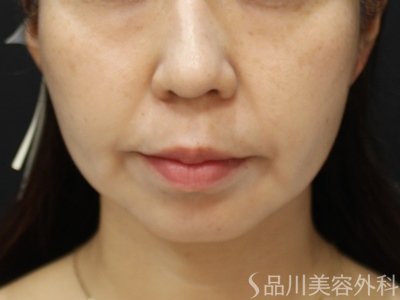 症例NO.75123のAFTER写真