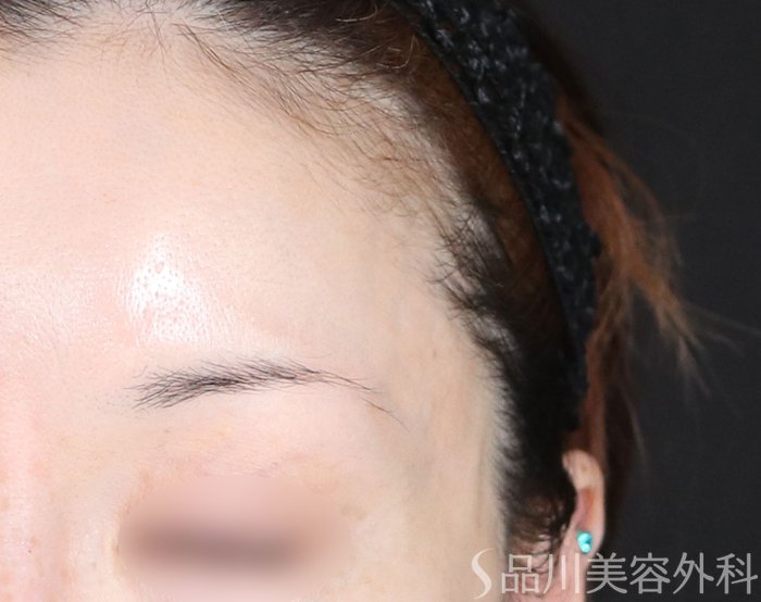 症例NO.72586のAFTER写真