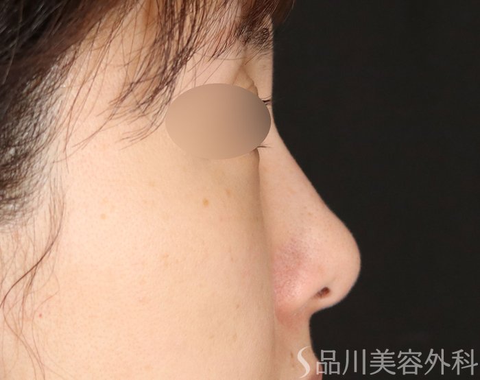 症例NO.72067のBEFORE写真