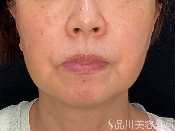 症例NO.71826のBEFORE写真