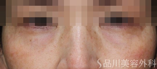 症例NO.68362のBEFORE写真