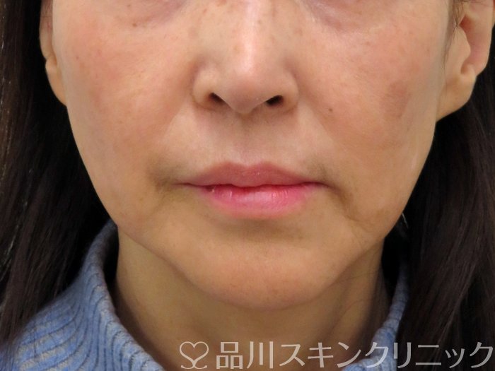 症例NO.73763のAFTER写真