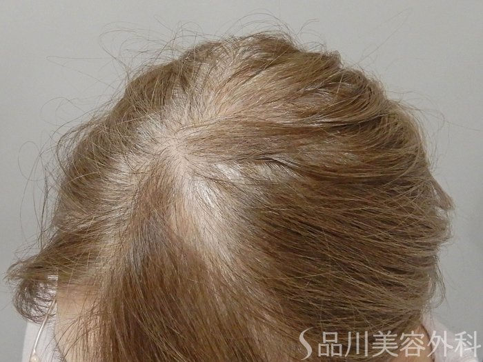 症例NO.69782のBEFORE写真