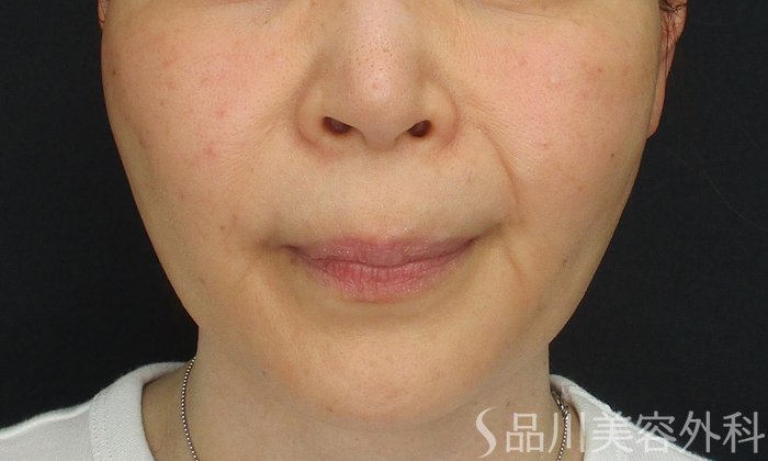 症例NO.71264のAFTER写真