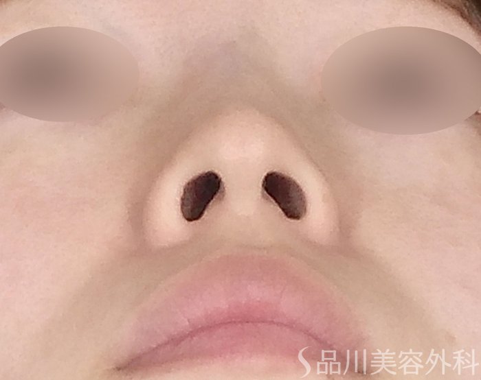 症例NO.71709のBEFORE写真