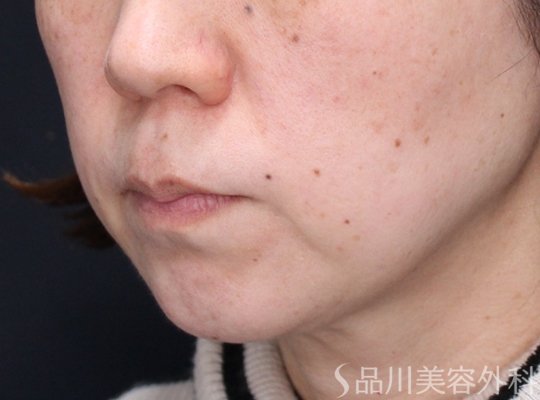 症例NO.73872のBEFORE写真