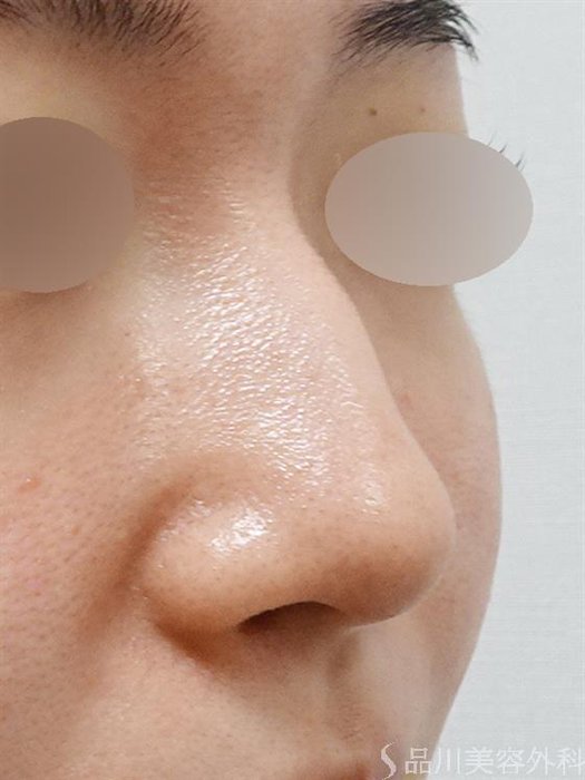症例NO.51490のBEFORE写真