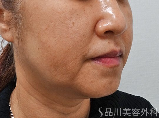 症例NO.73847のBEFORE写真