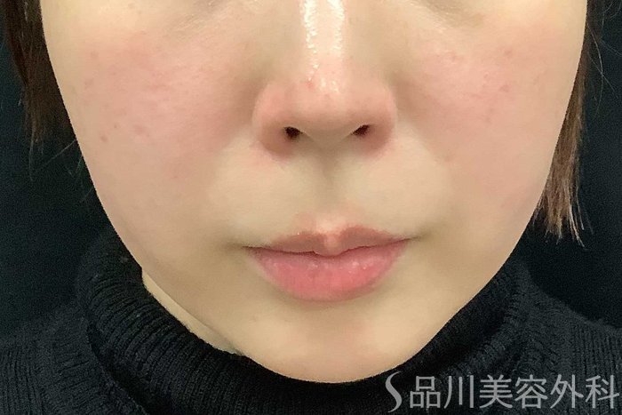 症例NO.62966のBEFORE写真