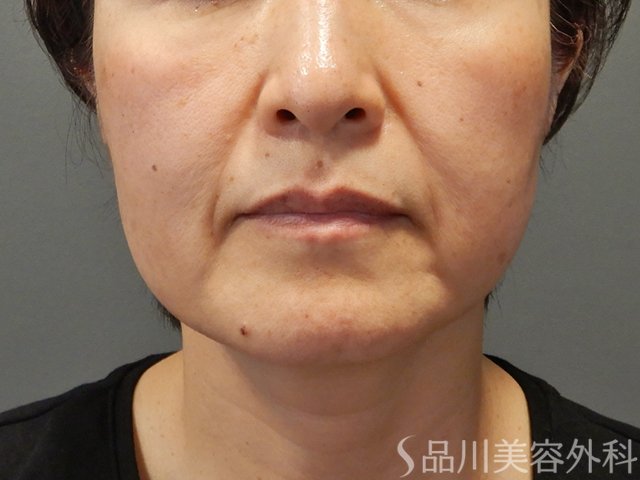 症例NO.75060のBEFORE写真