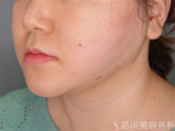症例NO.55083のAFTER写真