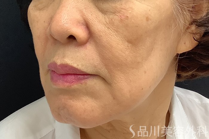 症例NO.71242のBEFORE写真