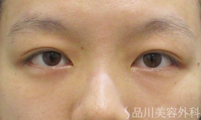 症例NO.71894のAFTER写真