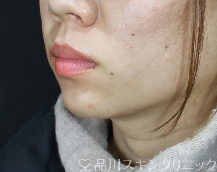 症例NO.69402のAFTER写真
