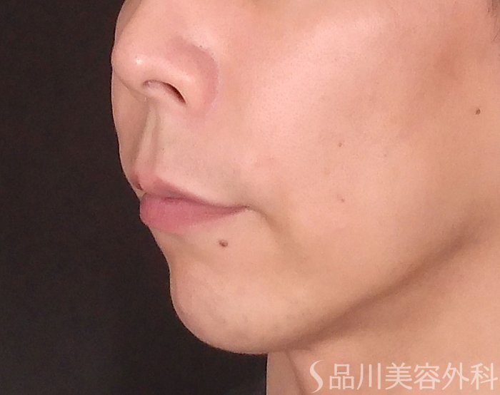 症例NO.70483のBEFORE写真