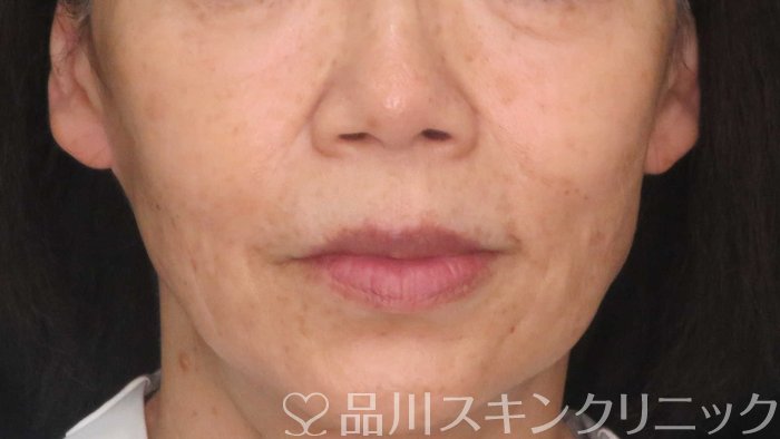 症例NO.71010のBEFORE写真