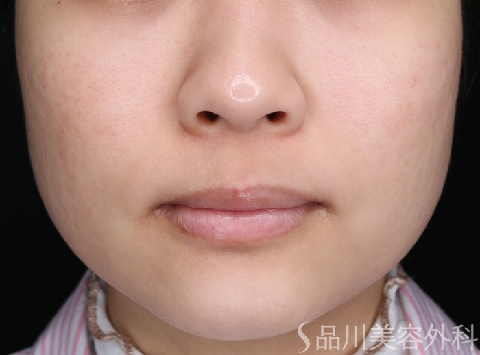 症例NO.65707のAFTER写真