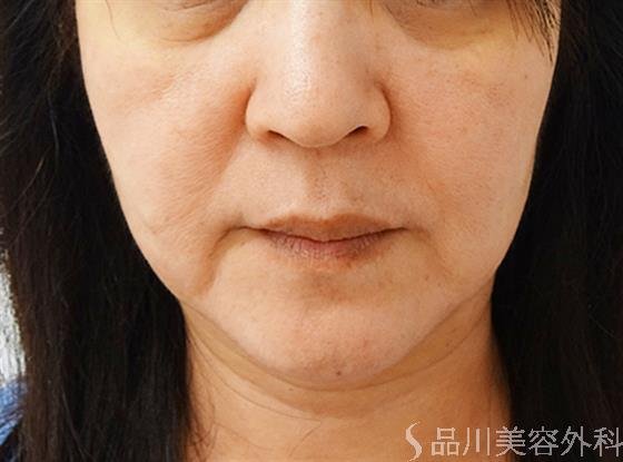 症例NO.36277のBEFORE写真