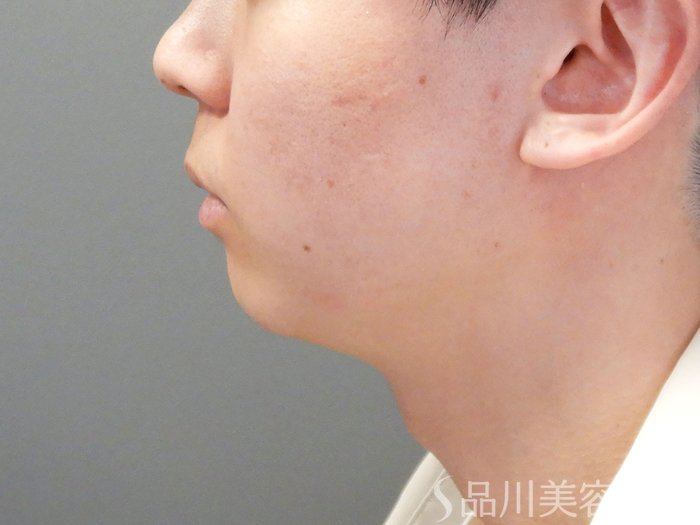 症例NO.70193のBEFORE写真