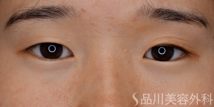 症例NO.73733のBEFORE写真