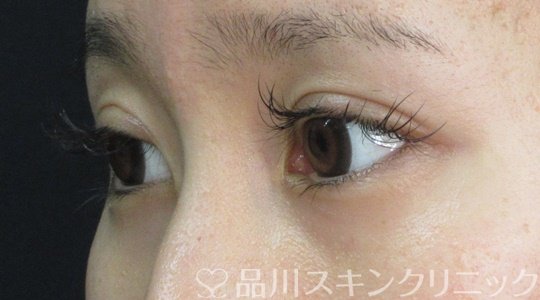 症例NO.71391のAFTER写真