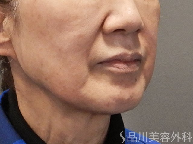 症例NO.73096のBEFORE写真