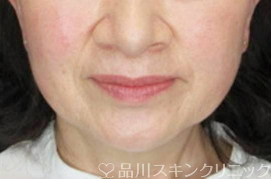 症例NO.74473のBEFORE写真