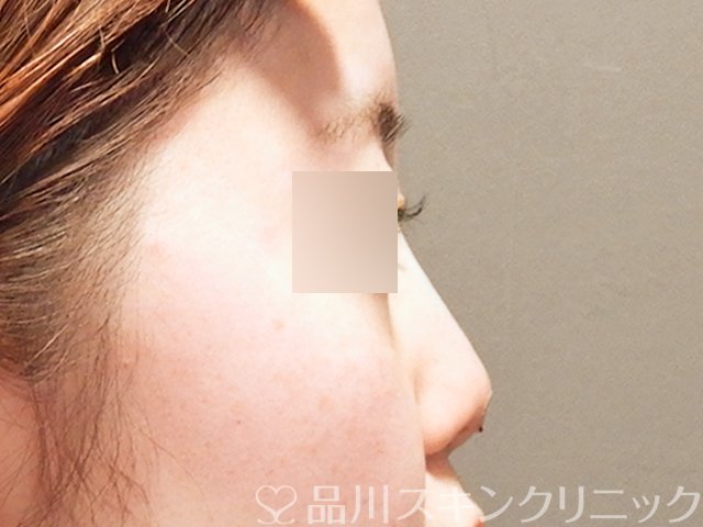 症例NO.69297のAFTER写真