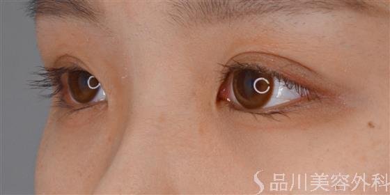 症例NO.56000のAFTER写真