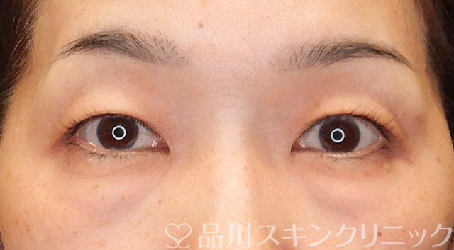 症例NO.75318のBEFORE写真