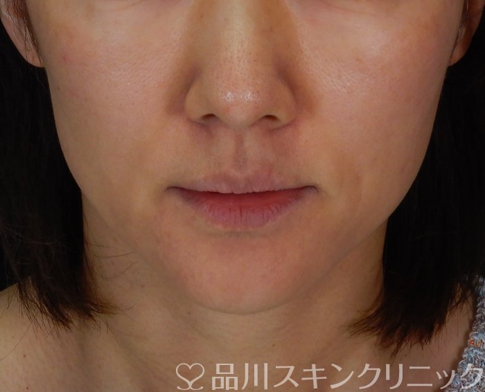 症例NO.66425のBEFORE写真