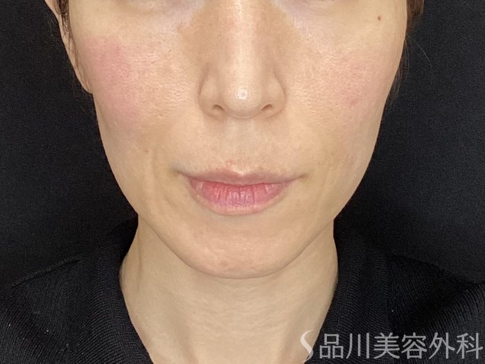 症例NO.72126のBEFORE写真