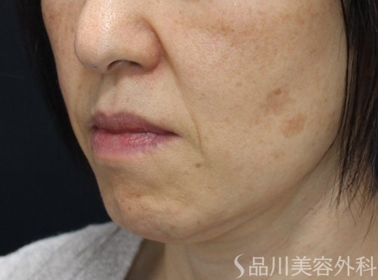 症例NO.75262のBEFORE写真