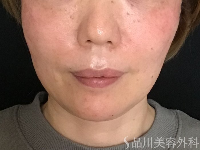 症例NO.65297のAFTER写真