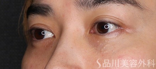 症例NO.74492のAFTER写真