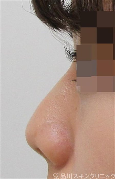 症例NO.40558のAFTER写真