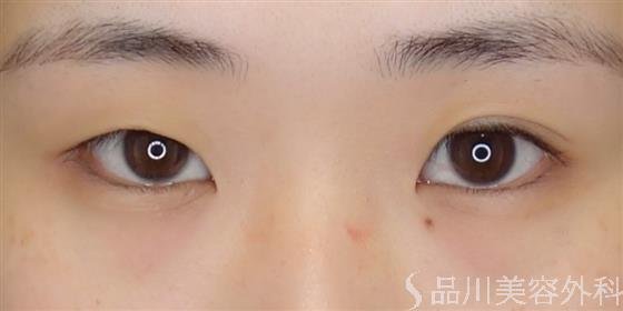 症例NO.50656のBEFORE写真