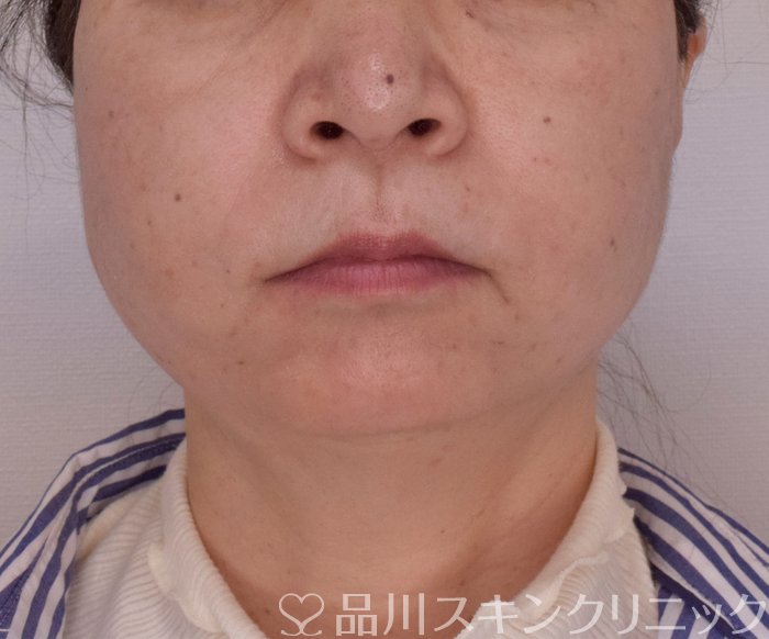 症例NO.69420のAFTER写真